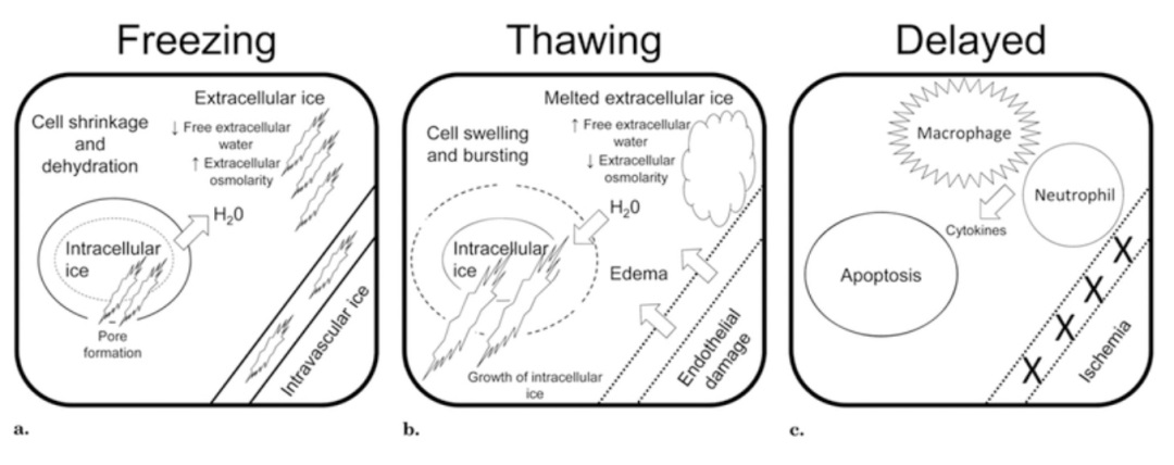 腫瘤治療界的「高冷之花」——腫瘤微創(chuàng)冷凍消融，國(guó)產(chǎn)替代設(shè)備空間巨大